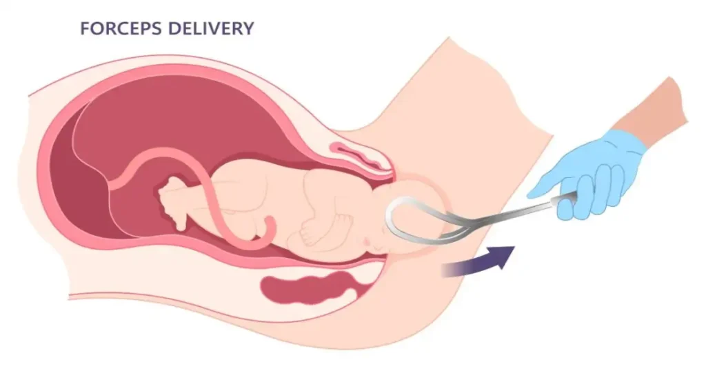 illustration of a forceps delivery used in Forceps Birth Injury: