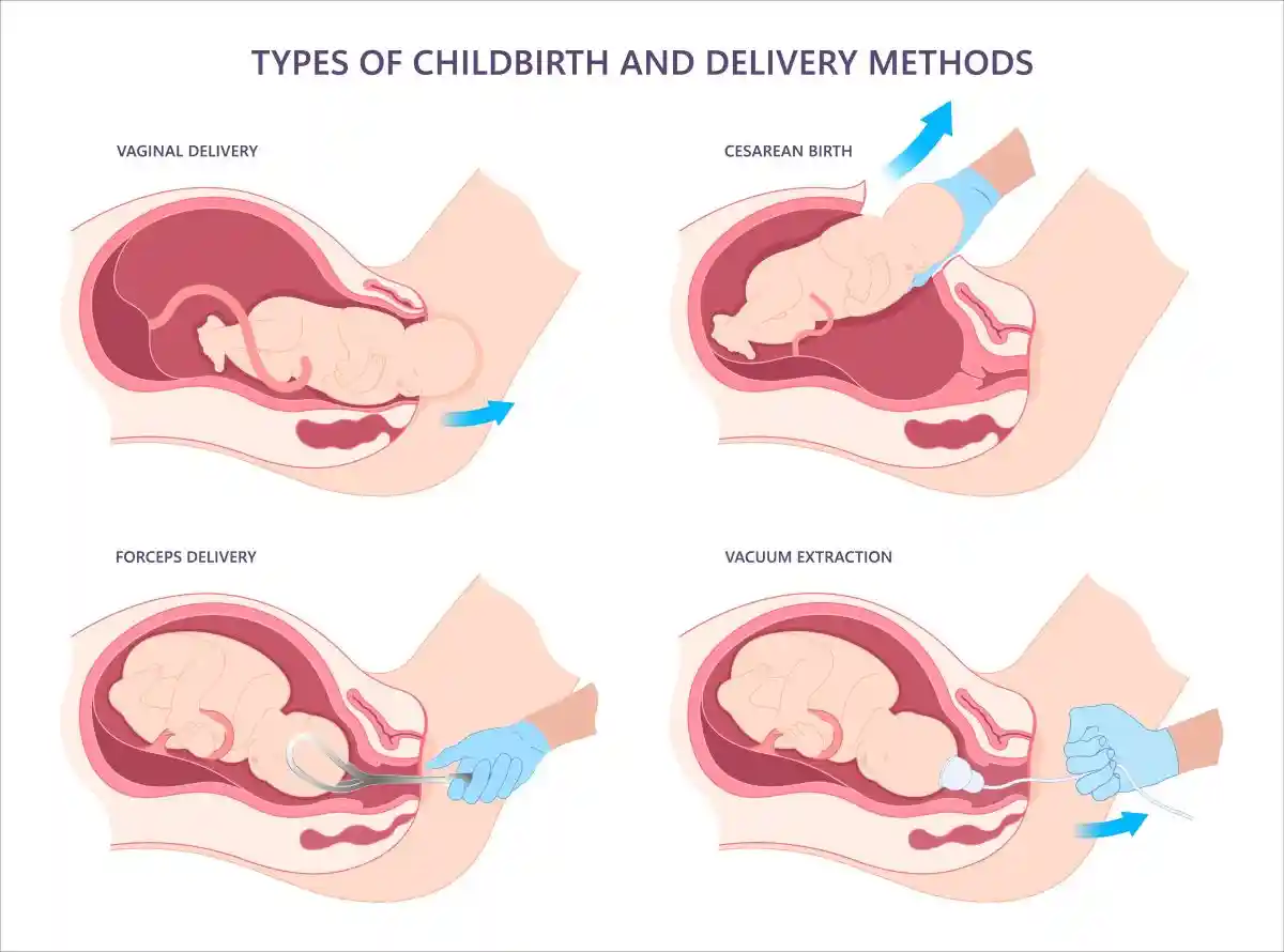 Fetal Childbirth Cesarean C Section the procedure in medical Occiput Anterior Delivery to pull baby from uterus facial palsy and scalp edema pain Forceps Assisted Vacuum Vaginal labor
used in forceps delivery complications